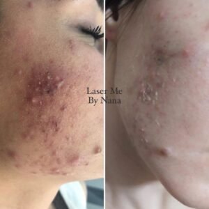 Acne treatment before and after results