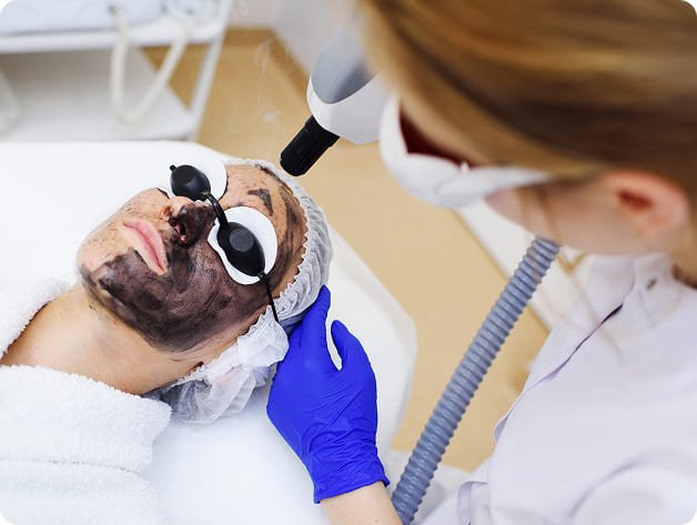 Carbon Laser Peel