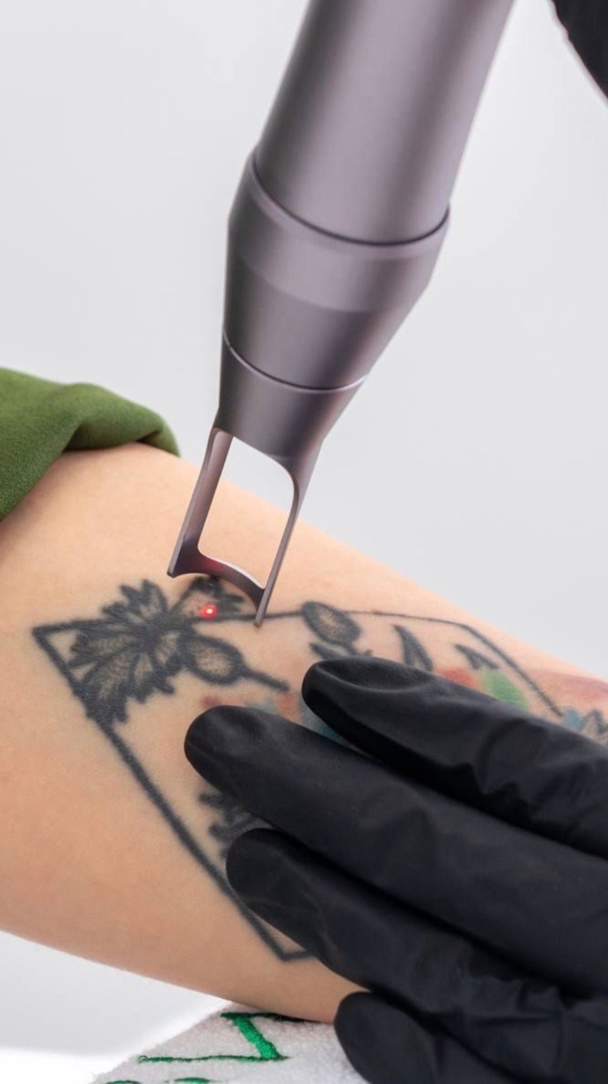 Laser tattoo removal treatment in Bali at Laser Me